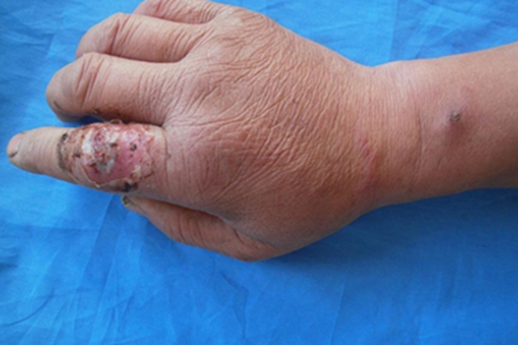 诺卡菌病手指溃疡图