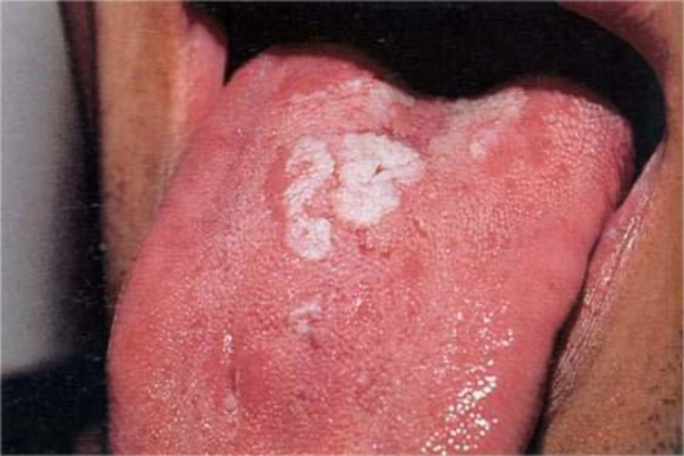 带状疱疹舌根白色假膜图