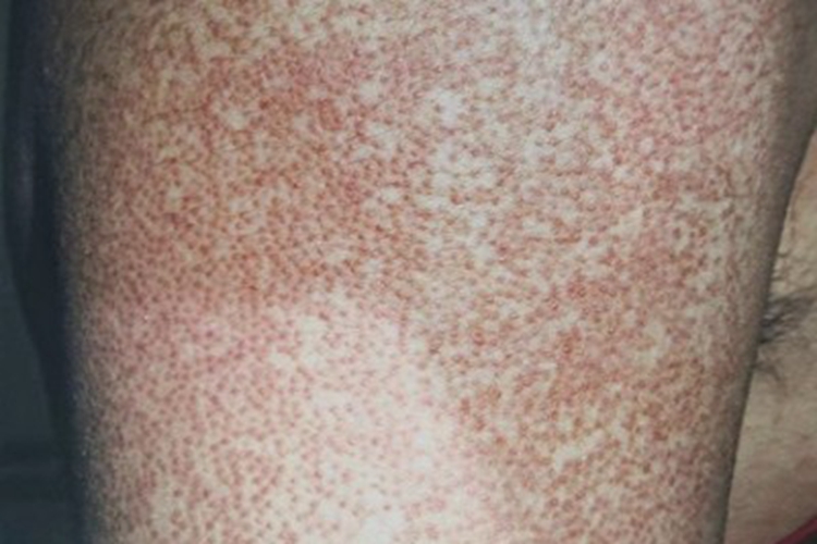 毛发扁平苔藓长红点图