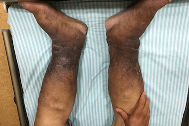 丝虫病小腿皮肤发黑图