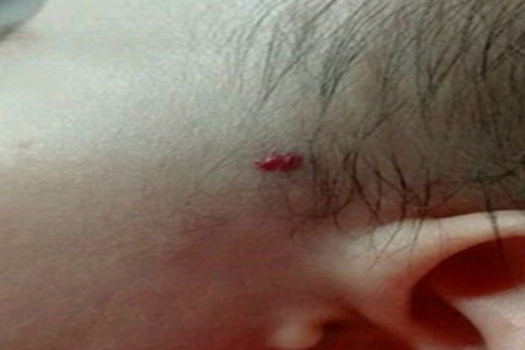 毛细血管瘤红点图 毛细血管瘤红点图