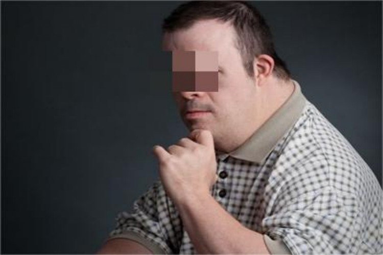 唐氏综合征面部症状图