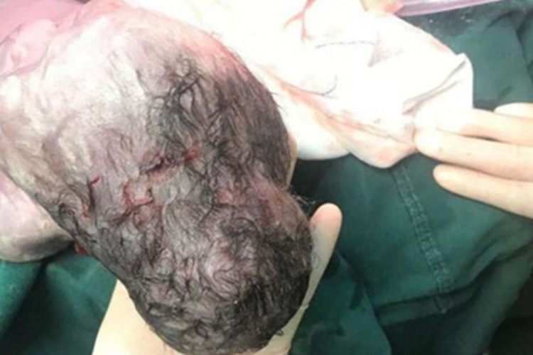 骨膜下血肿头部症状图