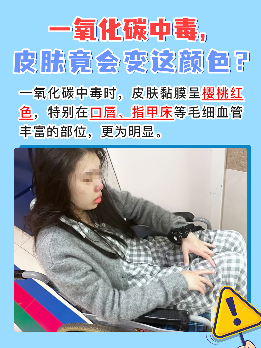 一氧化碳中毒，皮肤竟会变这颜色？