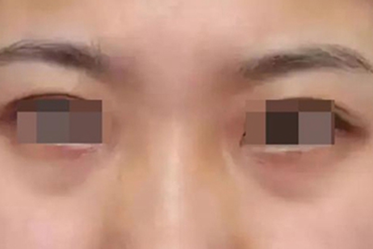 眶周黑变眼眶周围发黑图 眶周黑变眼眶周围发黑图