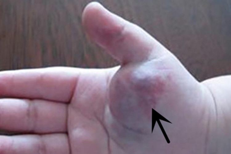 血管瘤手掌肿块图