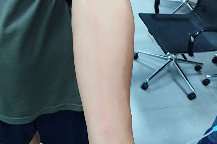 静脉炎红色条纹图