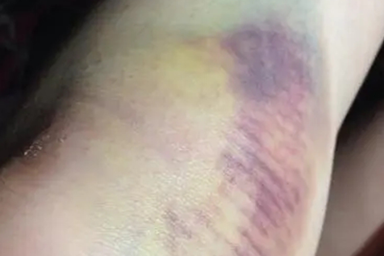 膝盖皮肤青紫图