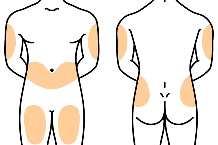 升白针皮下注射图 升白针皮下注射图