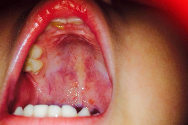 口腔溃疡上颚发红图 口腔溃疡上颚发红图