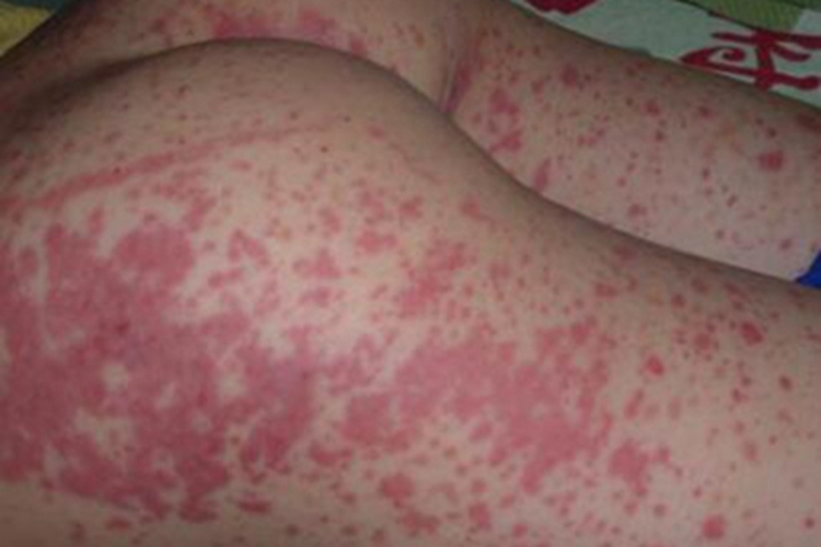 冷球蛋白血症血点图