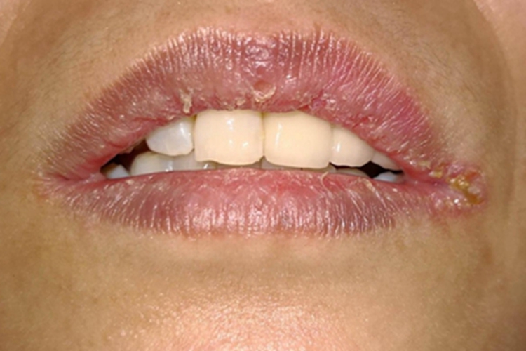 维生素B2缺乏症嘴唇糜烂图 维生素B2缺乏症嘴唇糜烂图