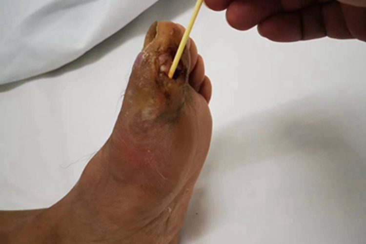 Ⅱ级糖尿病足症状图