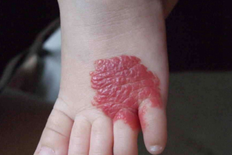 毛细血管瘤脚背症状图 毛细血管瘤脚背症状图