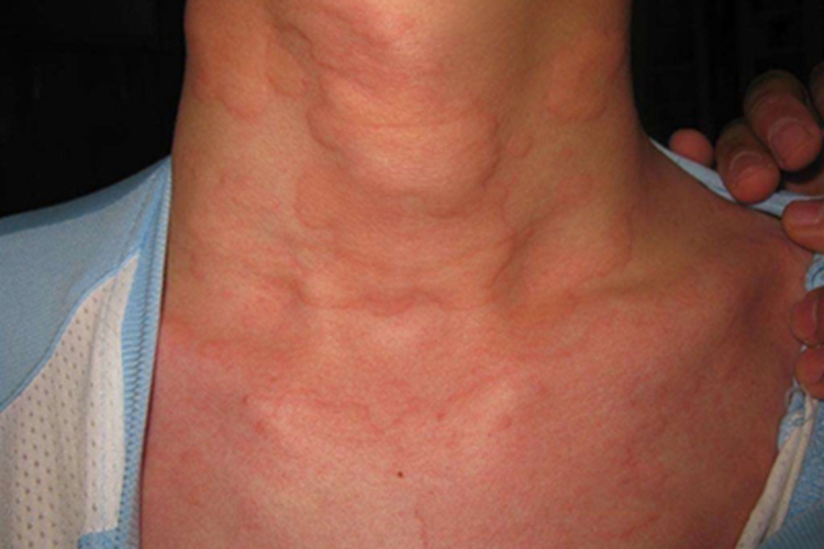 蠓性皮炎皮肤风团图 蠓性皮炎皮肤风团图