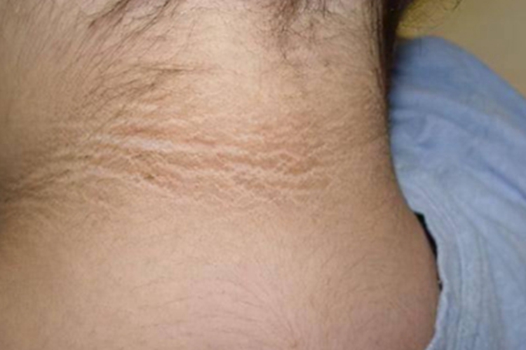 假性黑棘皮病颈部黑有颈纹图