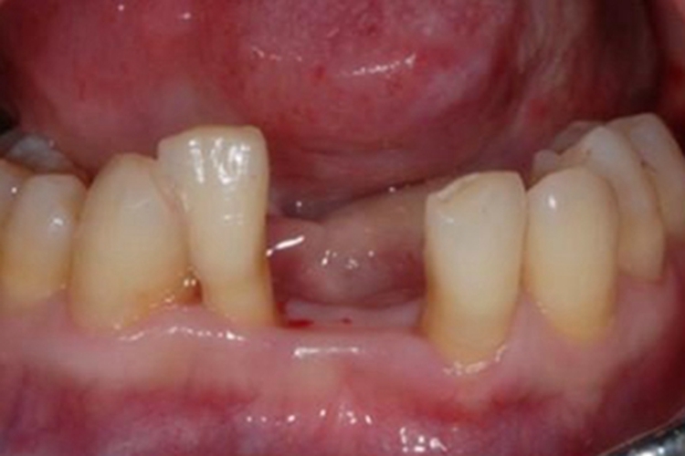牙龈萎缩龈肉发白图 牙龈萎缩龈肉发白图