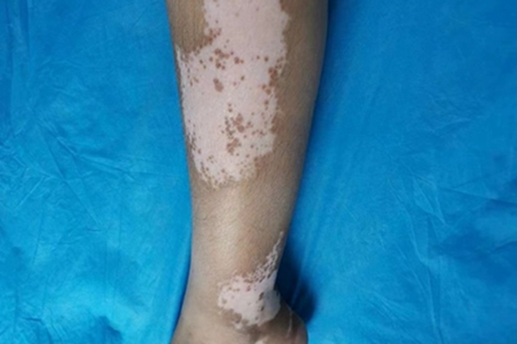 非节段型白癜风小腿长斑图