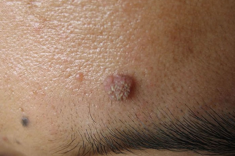 灰白色扁平丘疹,表面粗糙,逐渐增大并明显隆起于皮肤,外观可呈菜花状