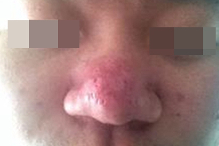 鼻赘型酒糟鼻鼻子红肿小坑图