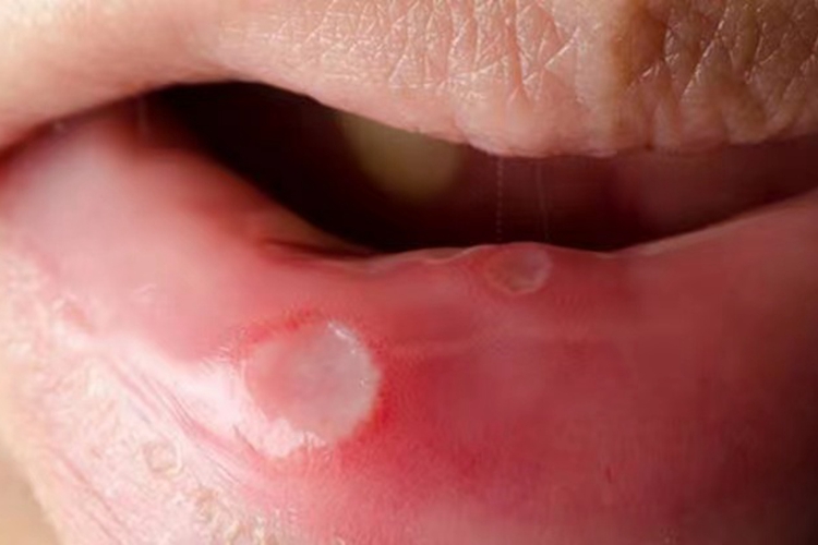 重型阿弗他溃疡图