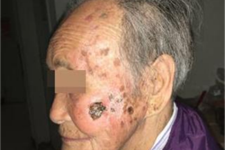 皮肤基底细胞癌溃疡图