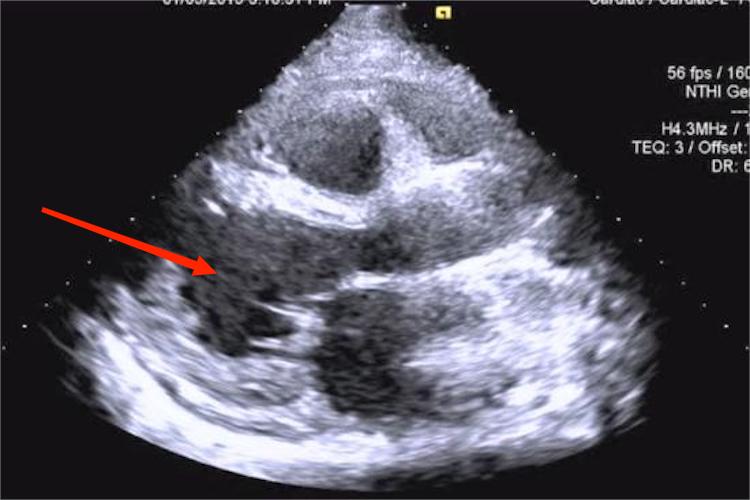 心肌炎超声心动图检查图 心肌炎超声心动图检查图