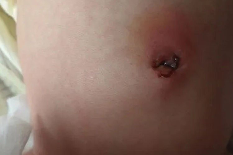 宝宝脐炎肚脐脓性分泌物图 宝宝脐炎肚脐脓性分泌物图