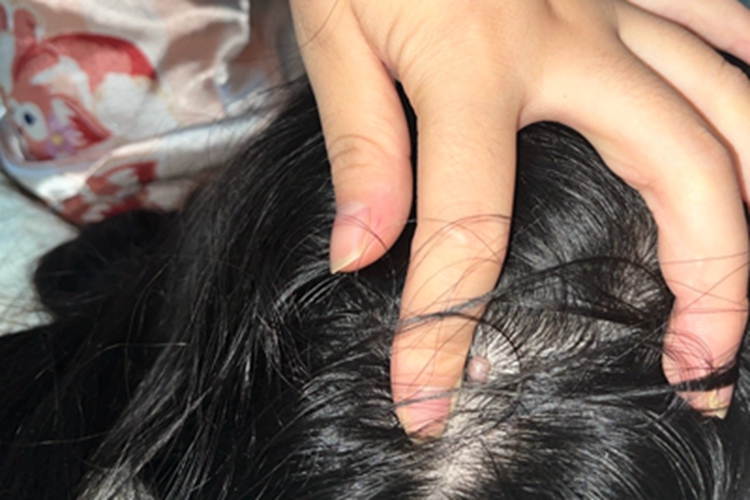 皮肤纤维瘤头皮症状图 皮肤纤维瘤头皮症状图