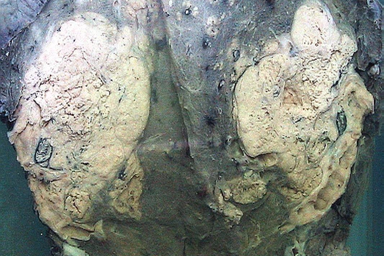 肺癌中央型肉眼观图