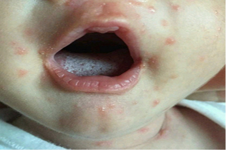 婴儿下巴水痘图