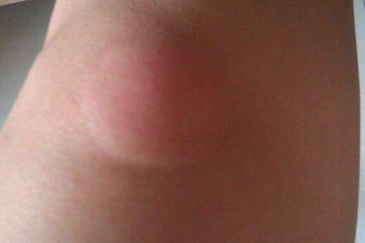 Ⅰ型痛性肥胖病膝盖上有大包图