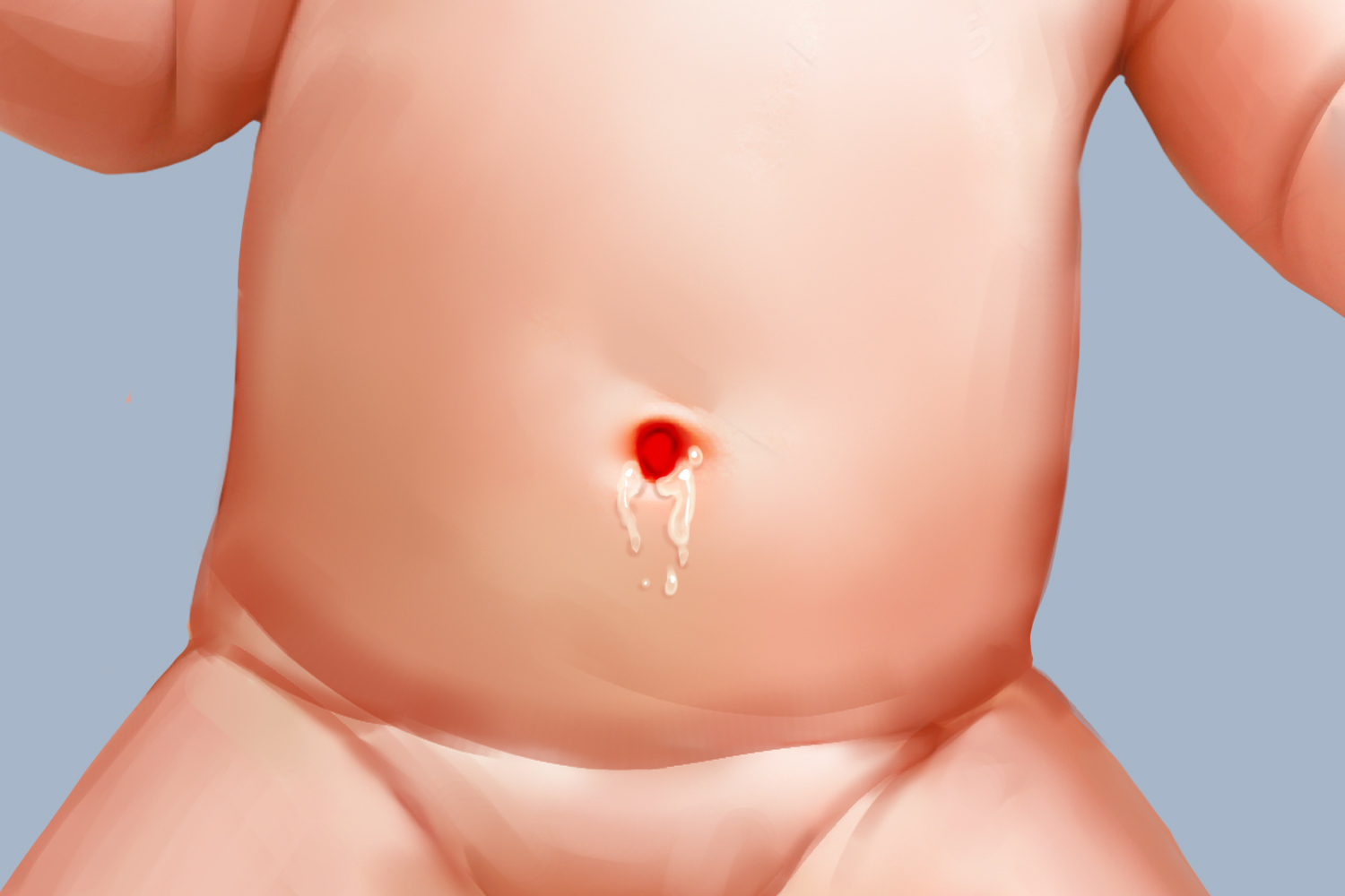 脐肠瘘肚脐下有个洞图