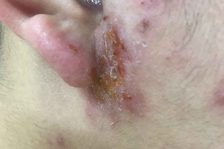 干燥后米黄色薄痂图