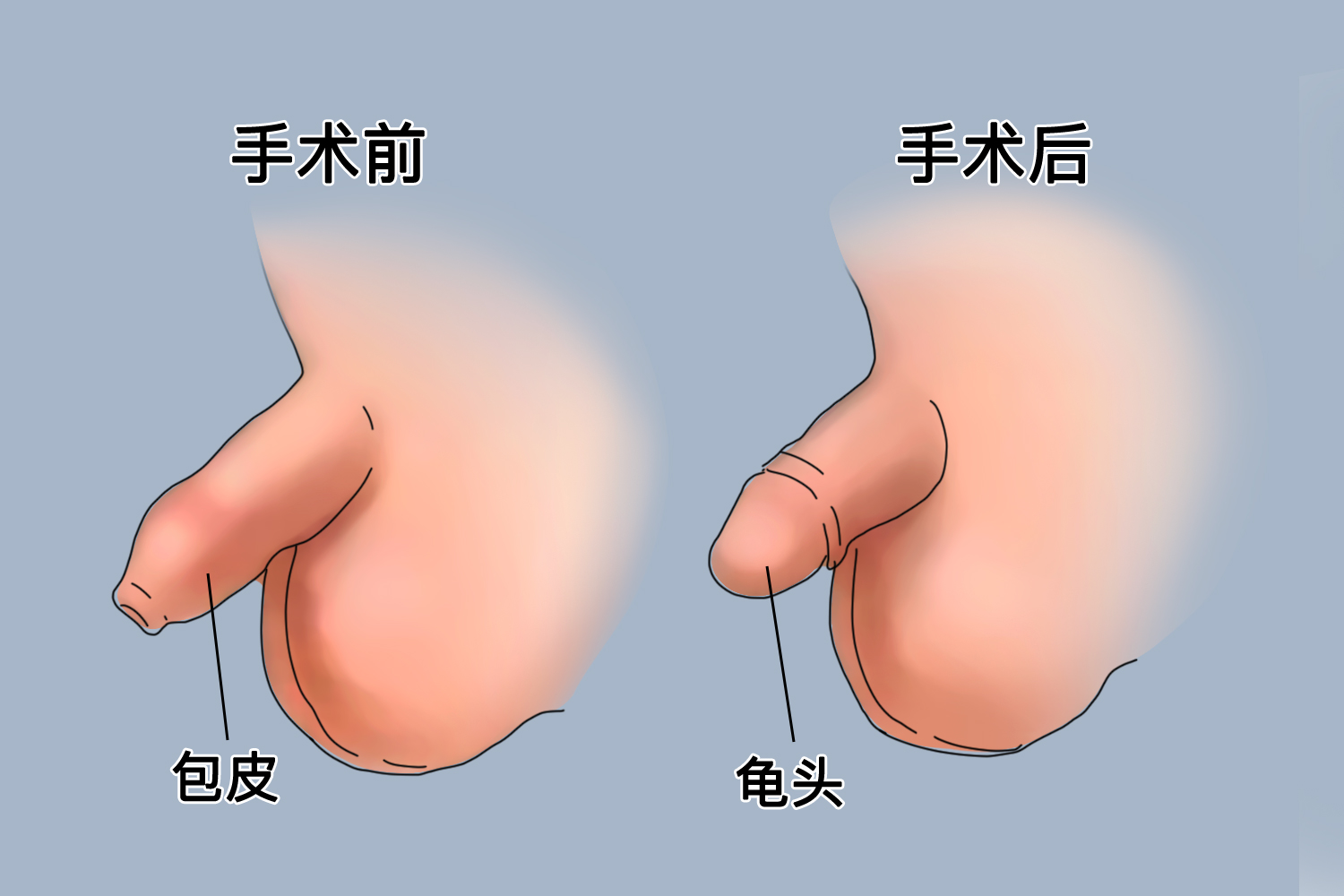 小孩包皮环切术后正常图 小孩包皮环切术后正常图