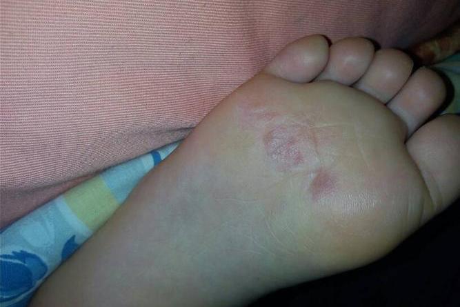 宝宝水疱型足癣初期症状图