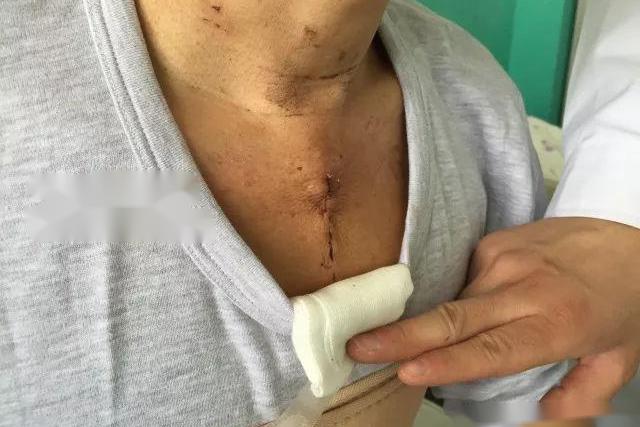 心脏搭桥手术瘢痕图 心脏搭桥手术瘢痕图