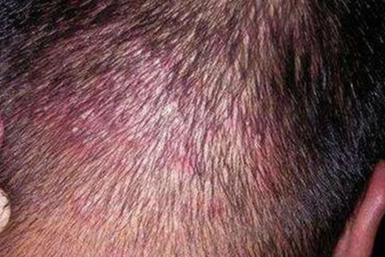 脱发性毛囊炎头皮小丘疹图