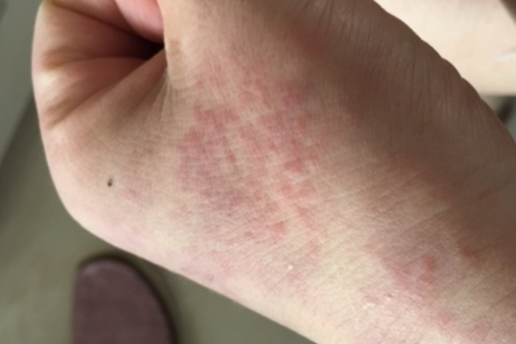 手背接触性皮炎图 手背接触性皮炎图