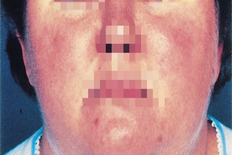 库欣综合征症状图