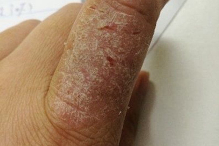 手部湿疹手指皲裂图