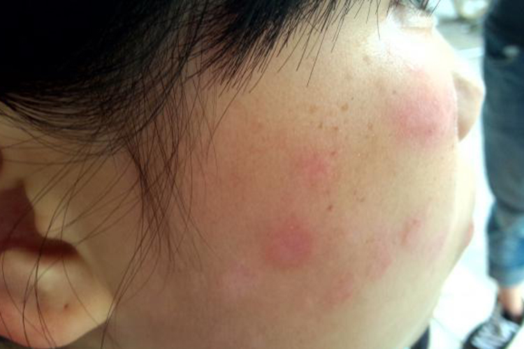 面部环形红斑图