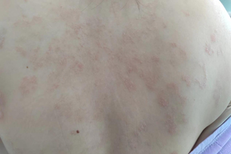 寻常型银屑病后背皮肤发红图