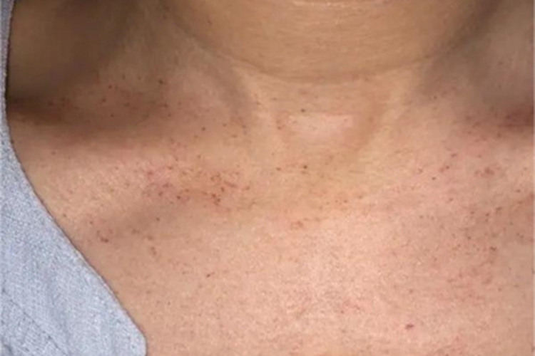 进行性色素性紫癜性皮病症状图