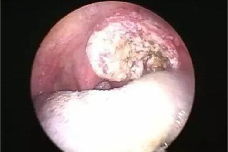 扁桃体恶性肿瘤溃疡图