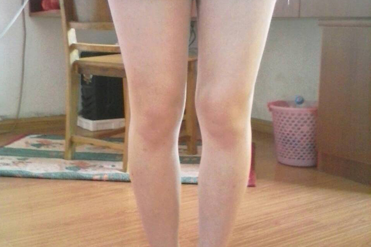 轻度O型腿图