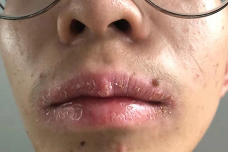急性光线性唇炎脱皮图 急性光线性唇炎脱皮图