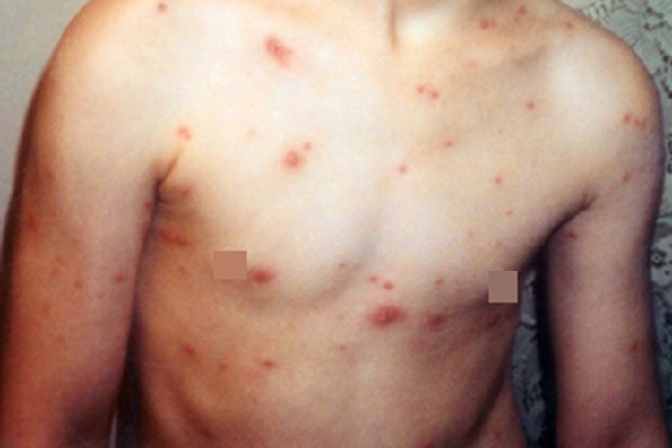 水痘全身大小不等的红疙瘩图 水痘全身大小不等的红疙瘩图
