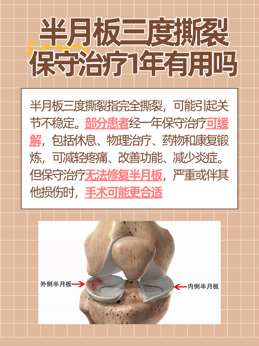 半月板三度撕裂：了解一年保守治疗是否有用