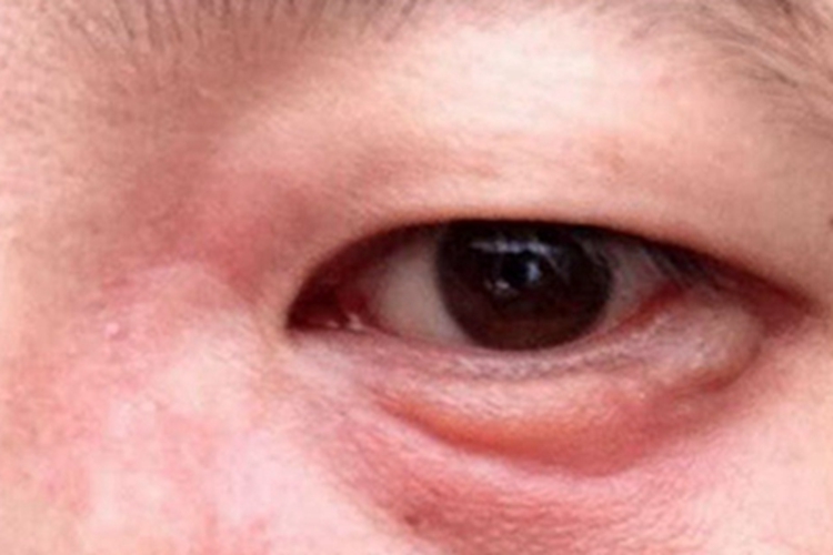 眦角性睑缘炎眼睑红肿图